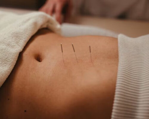 Dr. Natalia Llarena discusses Acupuncture and Endometriosis.